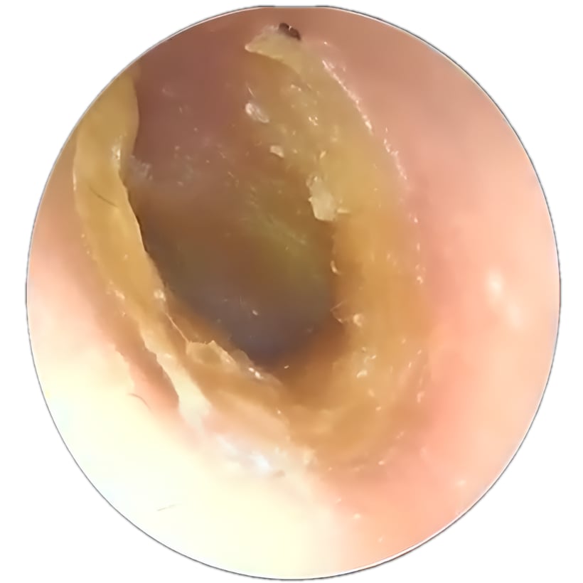 Close-up of an ear canal with visible earwax buildup.
