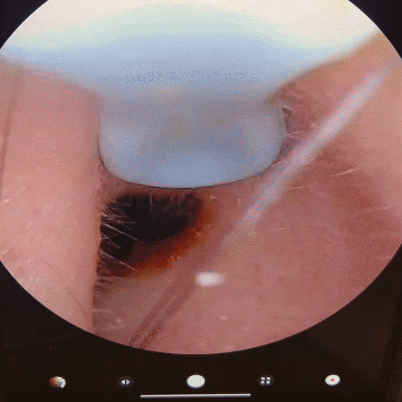 Close-up of an earwax removal process inside an ear canal.